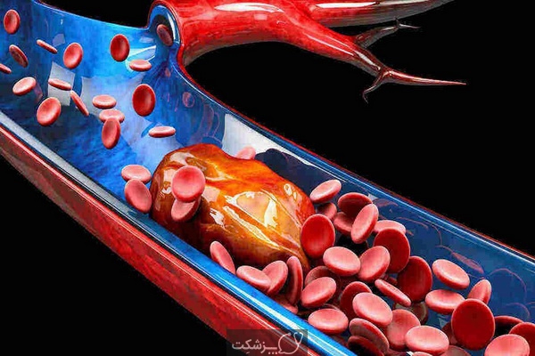 شایع ترین علائم لخته شدن خون | پزشکت
