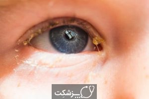 شایع ترین علل ترشحات چشمی | پزشکت