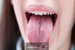 شایع ترین علل سفید شدن زبان | پزشکت