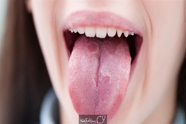 شایع ترین علل سفید شدن زبان | پزشکت