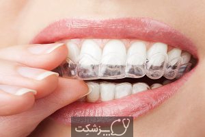 لکه های سفید روی دندان | پزشکت