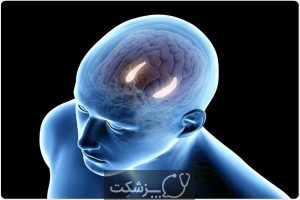 علائم آسیب به ناحیه راست و چپ مغز چیست؟ | پزشکت
