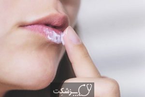 شایعترین زخم های دهان | پزشکت