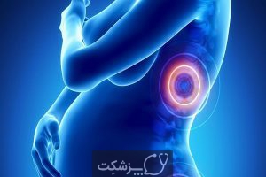 کمر درد در بارداری از علت تا درمان | پزشکت