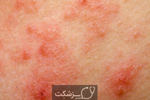 علل خارش زیر بغل چیست؟ علل خارش زیر بغل چیست؟