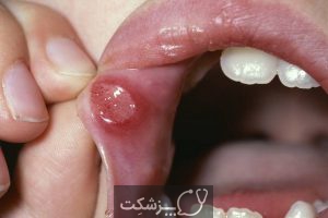 شایعترین زخم های دهان | پزشکت