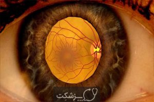 شایع ترین عوارض چشمی دیابت | پزشکت