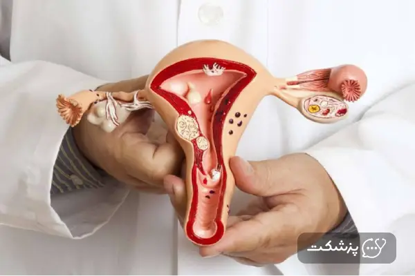مدل آناتومی رحم و واژن در دست پزشک برای توضیح برفک واژن