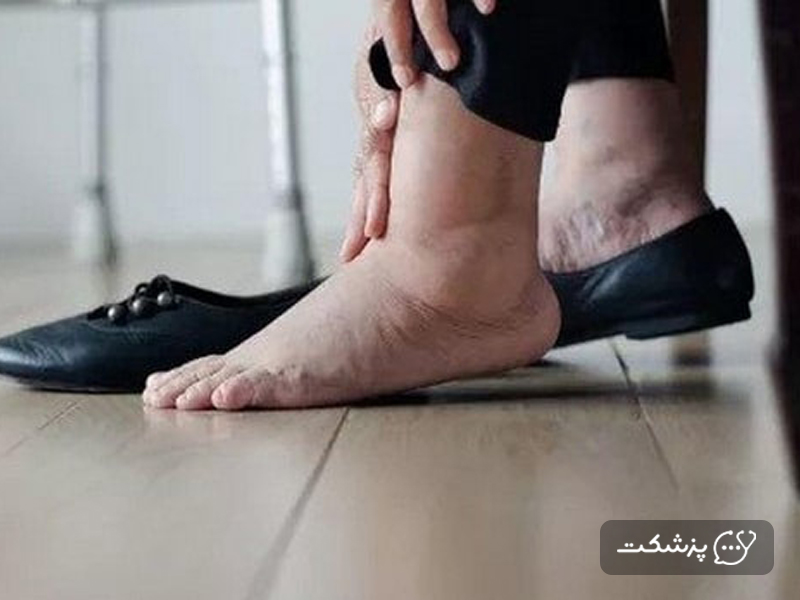 تورم در پا