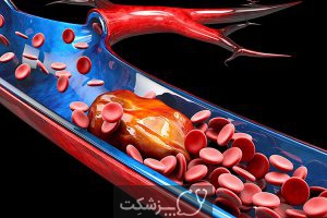 لخته شدن خون در بیماران کرونا | پزشکت