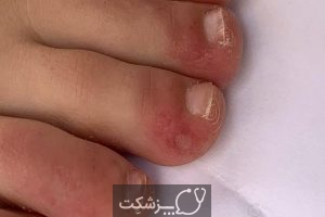 انگشتان 19 COVID از عوارض نادر کرونا | پزشکت