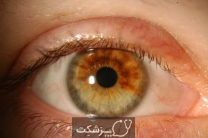 انواع سرطان های چشم | پزشکت