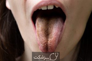 لکه های روی زبان | پزشکت