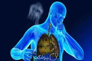 سرفه سیگاری | پزشکت