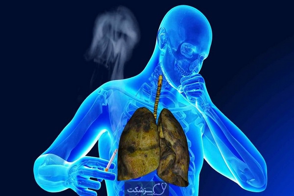 سرفه سیگاری | پزشکت
