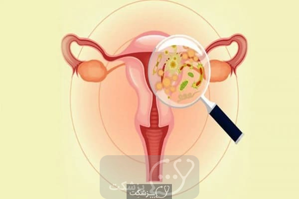 عفونت های قارچی از دلایل شایع ایجاد ترشحات واژن در زنان می باشد|| پزشکت