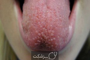 لکه های روی زبان | پزشکت