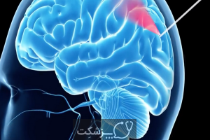 سرطان های مغز و اعصاب کدامند؟ | پزشکت