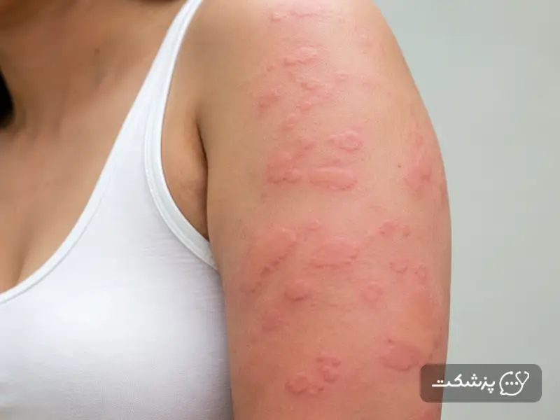 علت کهیر بعد از زایمان