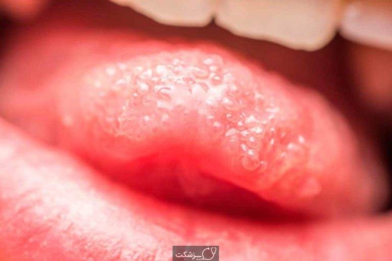 زبان در مورد سلامتی بدن چه می گوید؟ | پزشکت