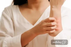 کهیر بعد از زایمان