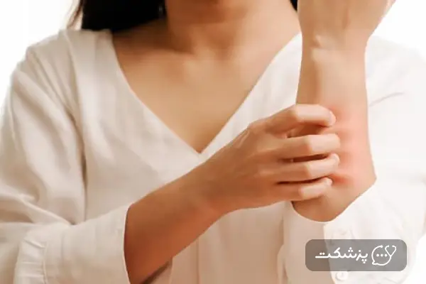 کهیر بعد از زایمان
