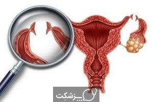 بستن لوله ها در زنان | پزشکت