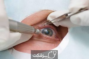 جراحی خشکی چشم | پزشکت