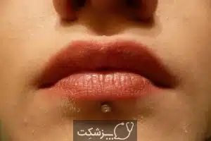 عقب رفتن لثه ها | پزشکت