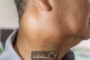 شایع ترین علت توده های پشت گردن | پزشکت