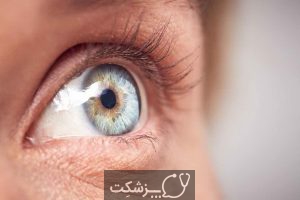 سرطان چشم | پزشکت
