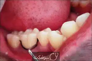 عقب رفتن لثه ها | پزشکت