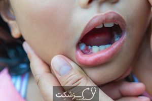 پالپکتومی دندان چیست؟ | پزشکت