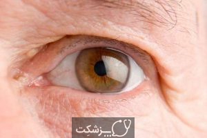 سرطان چشم | پزشکت