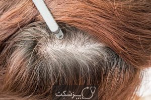 علل کم پشتی موی مردان و درمان آن | پزشکت