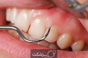 عقب رفتن لثه ها | پزشکت