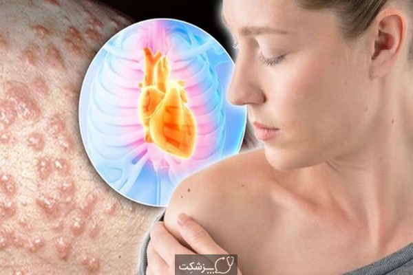 علائم هشدار دهنده پوستی برای بیماری های قلبی | پزشکت