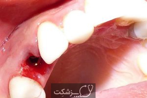 مراقبت های بعد از کشیدن دندان | پزشکت