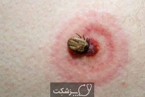 آلرژی به گزش حشرات | پزشکت
