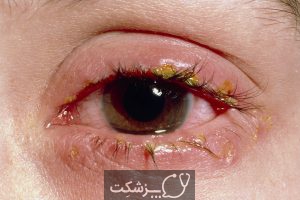 علت ضایعات پوستی اطراف چشم چیست؟ | پزشکت