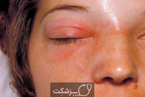 علت ضایعات پوستی اطراف چشم چیست؟ | پزشکت