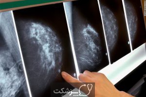 سرطان پستان متاستاتیک | پزشکت