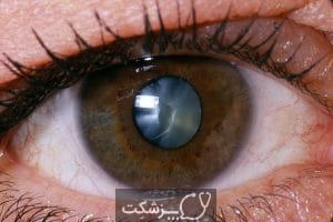 لکه چشمی بعد از آب مروارید | پزشکت