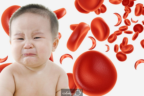 کم خونی داسی شکل در کودکان | پزشکت