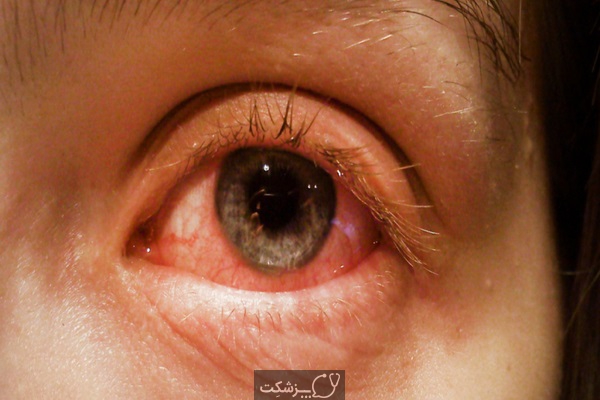 عوارض مایع منی بر روی چشم | پزشکت