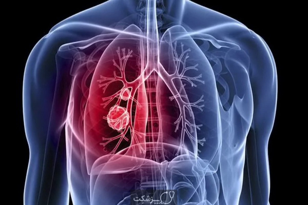 آیا گره یا ندول در ریه خطرناک است؟ | پزشکت