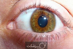 رنگ چشم ها و خطر بروز بیماری ها | پزشکت
