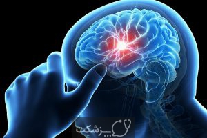 انواع بیماری عروق مغزی | پزشکت
