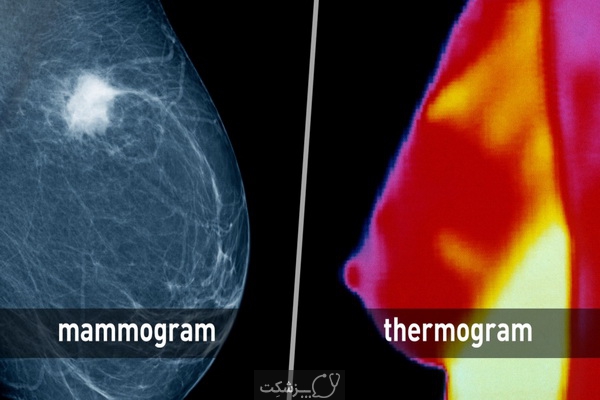 فرق بین ماموگرافی و ترموگرافی چیست؟ | پزشکت