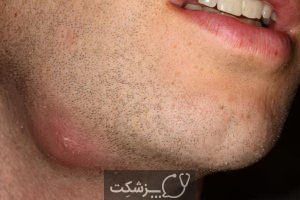 سرطان گره های لنفاوی | پزشکت